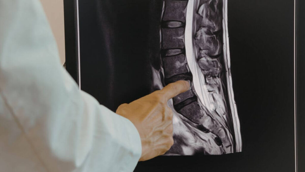 The Science Behind Spinal Decompression